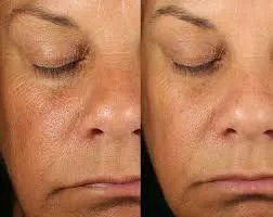 Tratamientos faciales y corrección de manchas con precisión médica